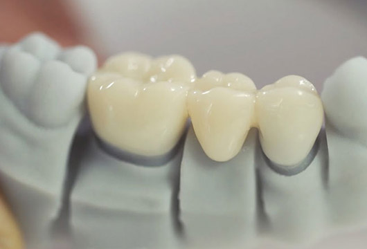 Зубной мост из металлокерамики