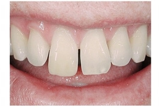 зубы до установки композитных виниров