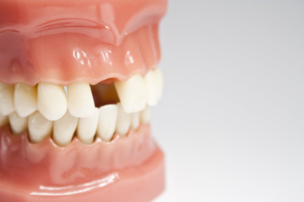 методы протезирования зубов