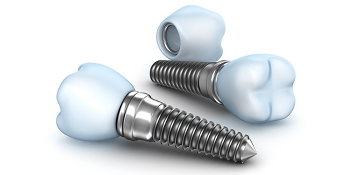 имплантация зубов есть ли вред