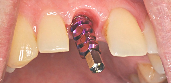 имплантация зубов без разреза десны