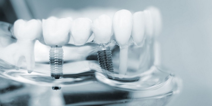 метод имплантации зубов