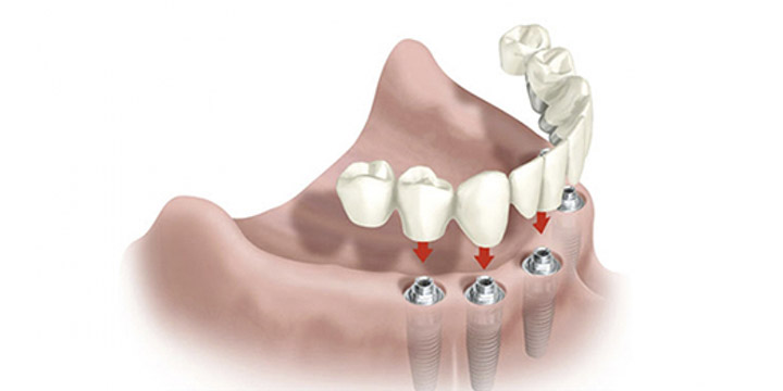 Полная имплантация при отсутствии зубов