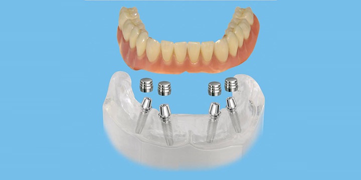 имплантация при отсутствии всех зубов