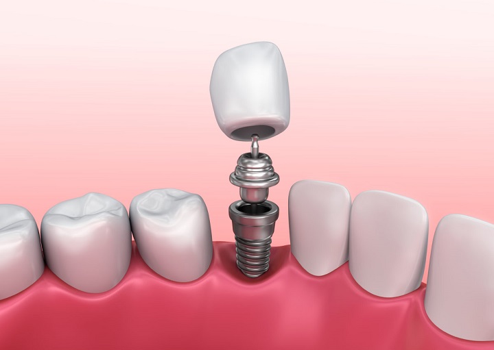 современные технологии имплантации зубов