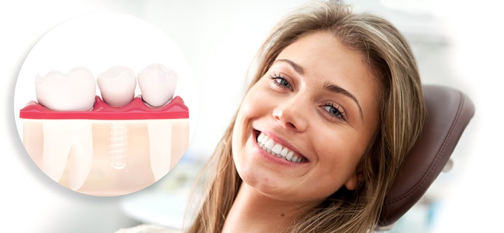 Имплантация зубов у женщин