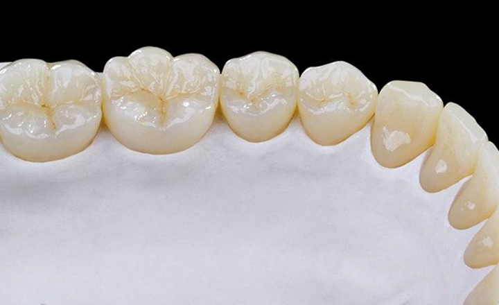 Коронки на жевательные зубы