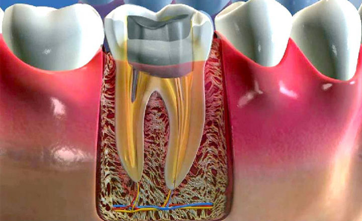 восстановление культи зуба