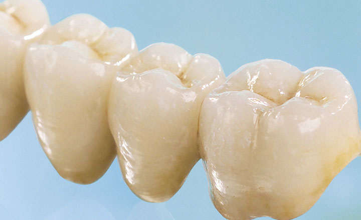 восстановление зубов коронками или винирами