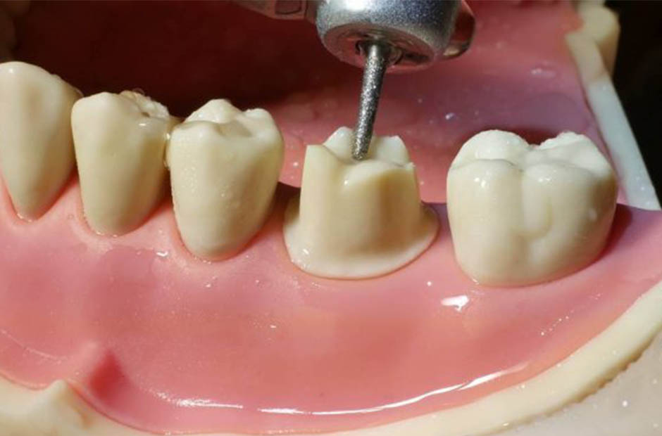 готовимся к современному протезированию зубов