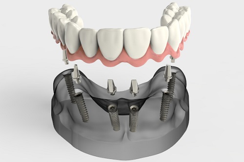 Имплантация All-on-6